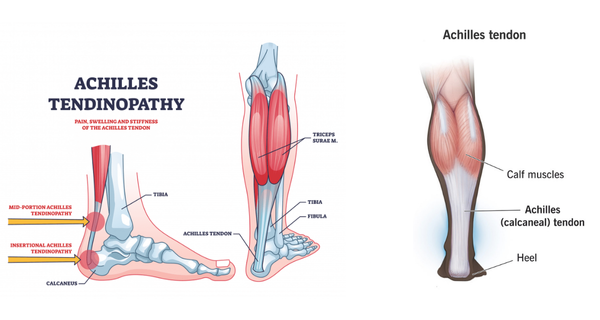 Achilles Tendonitis