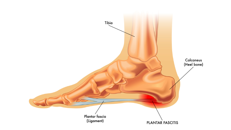 Plantar Fasciitis