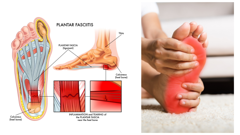 Plantar Fasciitis