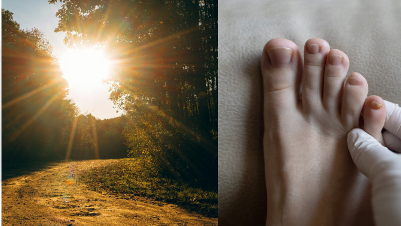Fungal Nails Need Sunlight