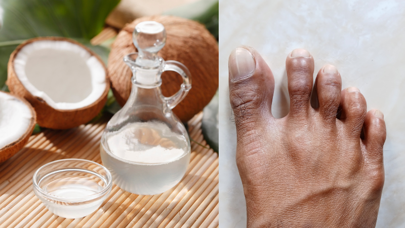 Help Treat Fungal Toe Nails with Coconut Oil