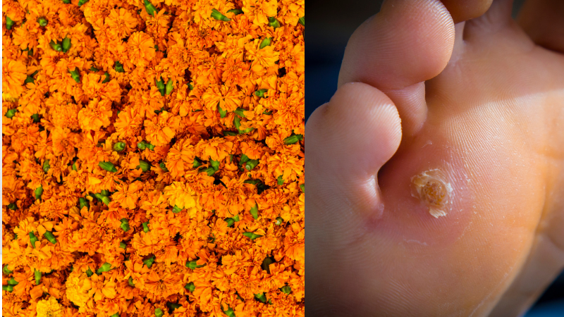 Treat Warts and Calluses with Marigold