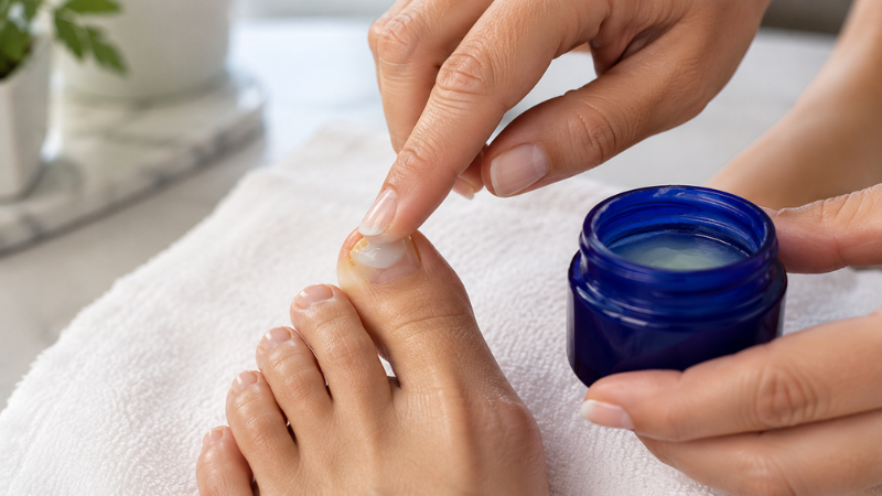 Vicks VapoRub toenail fungus treatment being applied to a fungal toenail